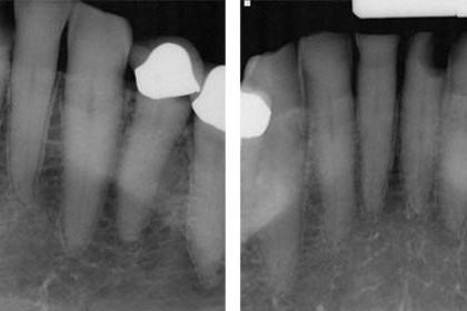 25号牙D3远端近端病变x线片. 这种被称为SMART的技术可以帮助修复牙齿损伤，防止龋齿，而不需要多次预约.
